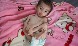 Gazze'de Zekeriyya bebek, yetersiz beslenmeyle mücadele ediyor